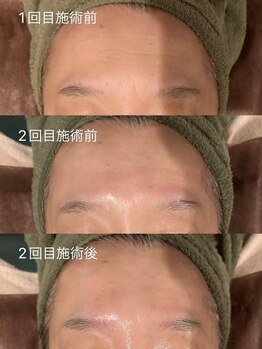 エステサロン ジュエル 高松レインボー店(JEWEL)/エアバリフェイシャル