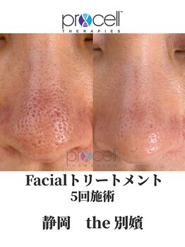 ザ ベッピン(the 別嬪)/毛穴も大得意！プロセル