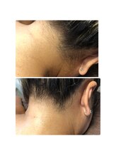 ツリービューティー(Tree Beauty)/★うなじ脱毛★