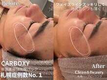 クリーンアンドビューティ 札幌(Clean&Beauty)/韓国強炭酸パック札幌症例数No.1