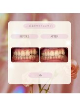 プラスビー 2号店(+b)/ホワイトニングビフォーアフター