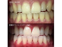 ◎なりたい白さで選べるセルフホワイトニング