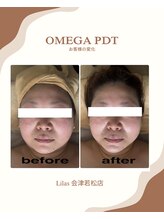 リラ(Lilas)/細胞までアプローチ！最新LED光