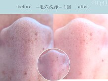 スキンラボアメリ(skin lab. ameri)/韓国式３D毛穴洗浄