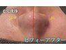 【20代向け】毛穴洗浄+ニキビケア ¥7,000-