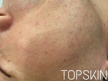 トップスキン 久屋大通(TOPSKIN)/男性の肌トラブルもお任せ下さい