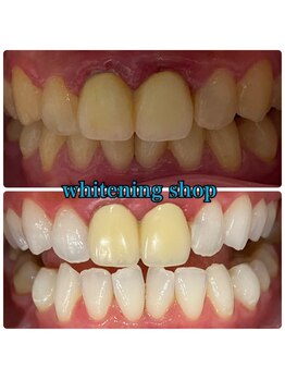 ホワイトニングショップ 盛岡店(WHITENINGSHOP)/被せ物のある方も♪