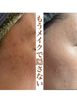 ハーブピーリングHY/ハーブピーリング