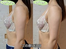スノードロップ(snowdrop)/20代の方のバストアップ