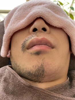 レストラン(Restaurant)/【メンズOK】話題のワックス脱毛