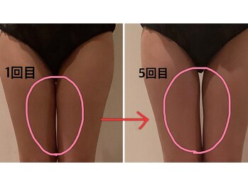 クレアボディ(CREA BODY)/太もも