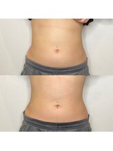 プルメリア(Plumeria)/くびれの左右差の変化！