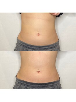 プルメリア(Plumeria)/くびれの左右差の変化!