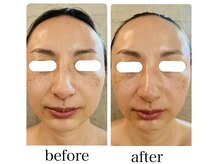 ニコリ(nicori)/小顔矯正　beforeとafter