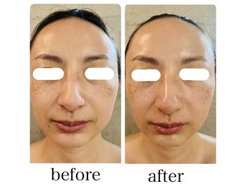 ニコリ(nicori)/小顔矯正　beforeとafter