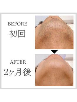 エクレ 今池店(EKURE)/ヒゲ脱毛