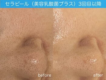 クレスト(CLEST.)/ララピールに美肌乳酸菌がプラス