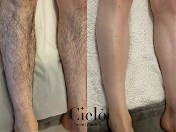 シエロ 町田店(Cielo)の写真/【リピーター続出★】Cieloのメンズ脱毛で毎日の髭剃りから解放されるチャンス！シュガーリング脱毛◎