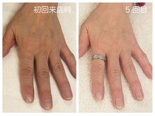 キレイテ 福岡天神店/50代/5回目【福岡ハンドケア】