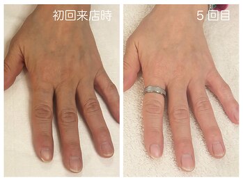 キレイテ 福岡天神店/50代/5回目【福岡ハンドケア】