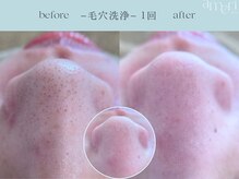 スキンラボアメリ(skin lab. ameri)/韓国式３D毛穴洗浄