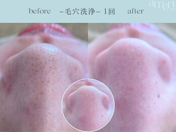 スキンラボアメリ(skin lab. ameri)/韓国式３D毛穴洗浄