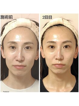 イル 名取店(iru)/糸式リフトアップフェイシャル