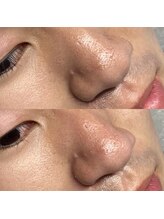 ビトタン 倉敷本店(+美to鍛)/鼻Wax脱毛