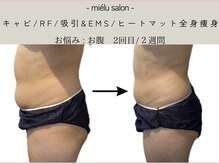 ミエル(mielu)/全身痩身　お腹メイン