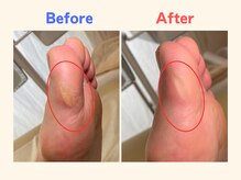 ピース/母趾のタコが痛い40代女性