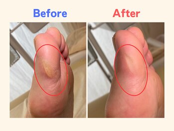 ピース/母趾のタコが痛い40代女性