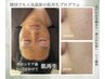 【メンズ＊ハーブピーリング】1回でも変化実感！15万本導入¥13,700