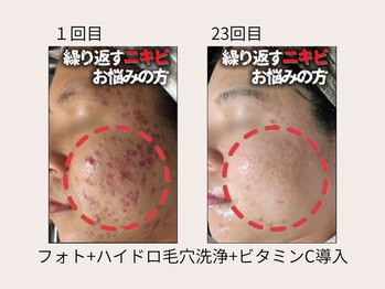 ビズビズ 梅田店(bisebise)/本気で肌を変えたい方は当店へ