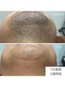 【新規男性/人気NO.1/短期間でカミソリいらず】ひげ光脱毛体験¥2200