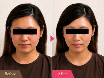 リアライズ(realise)の写真/ラジオ波フェイシャルと美容鍼で理想の小顔へ！憧れのフェイスラインを叶えます♪