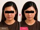 リアライズ(realise)の写真/ラジオ波フェイシャルと美容鍼で理想の小顔へ！憧れのフェイスラインを叶えます♪