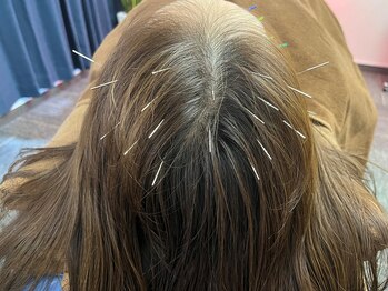 つばさはりきゅう院の写真/頭から整えて深いリラックスへ。人気の頭への電気鍼コース。
