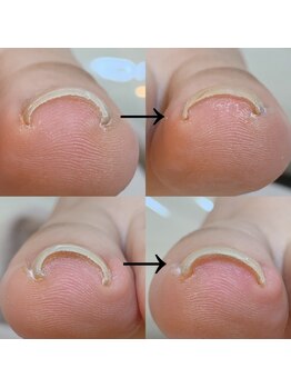 リリフリー(riri Free)/巻いてるお爪ケア