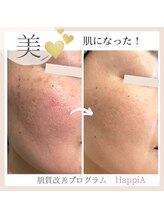 ハピア(HappiA)/肌質改善プログラム