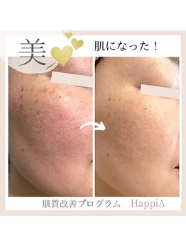 ハピア(HappiA)/肌質改善プログラム