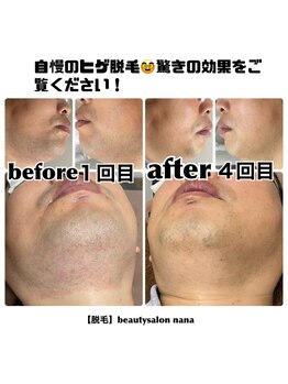 ナナ(nana)/自慢のひげ脱毛