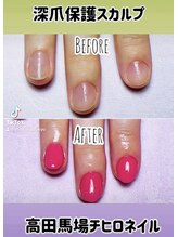 チヒロネイル/爪噛み保護スカルプ・深爪対策