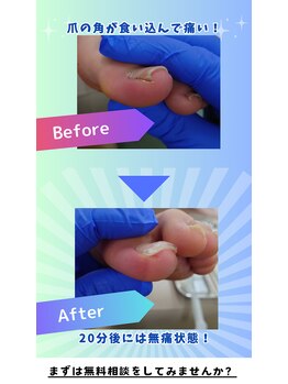 どうはく堂 西勝山接骨院/巻き爪補正