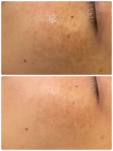 ニジ(Nizi)/悩みに合わせた肌質改善コース