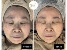 グレイス(Grace)/光フェイシャル