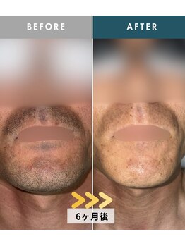 モモナ(Momona)/佐世保/脱毛/髭脱毛/全身脱毛