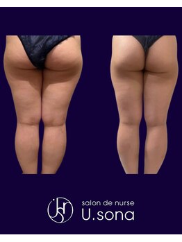 小顔・脂肪コントロール専門 salon de nurse U.sona～松本店～/【痩身】太もも脂肪分解症例