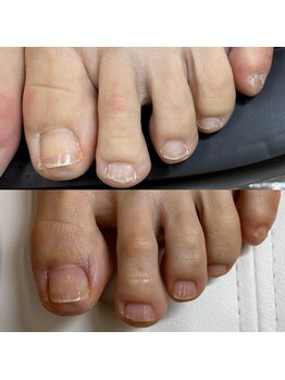 リリ(lili)/トータルフットケア1回目