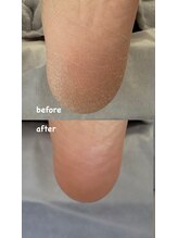 フットミー(foot mii)/１回目ビフォーアフター
