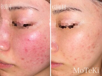 モテキ 表参道店(MoTeKi)/症例Befor/Afterニキビ・肌荒れ
